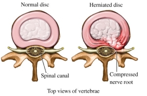 herniated disk las vegas