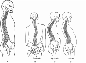 las vegas abnormal spinal curvature